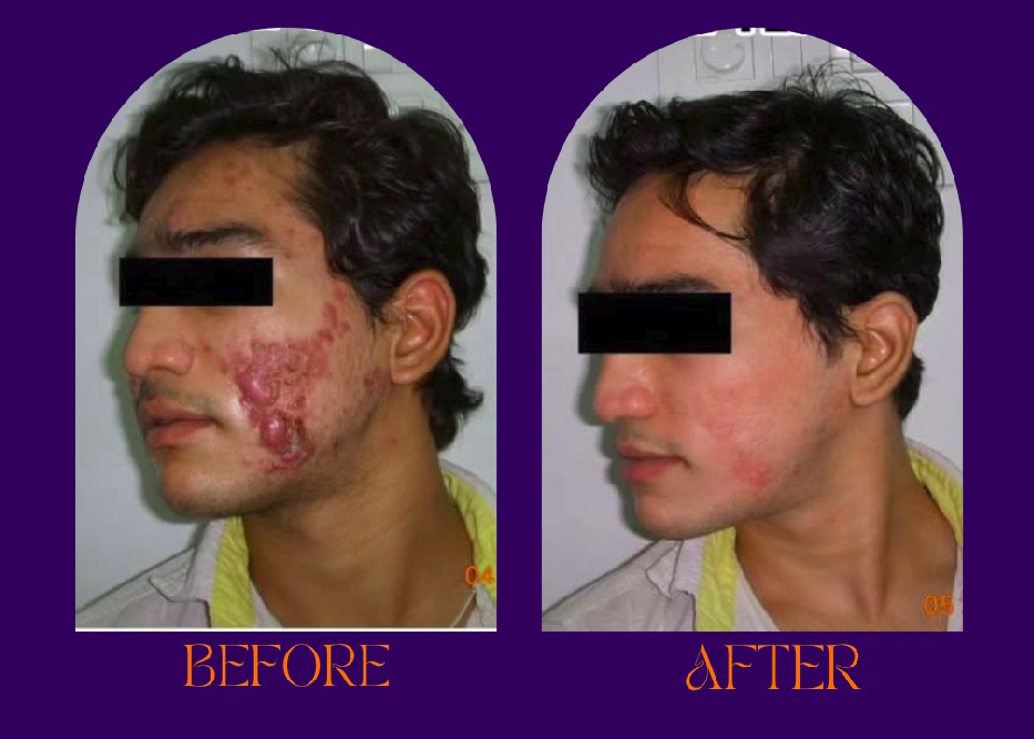 Pigmentation treatment before and after