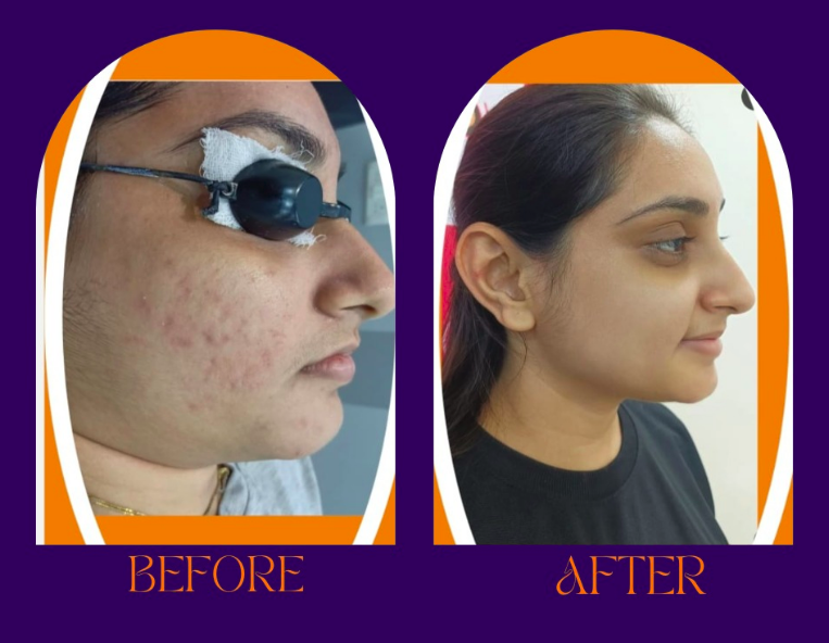 Active acne healing before and after